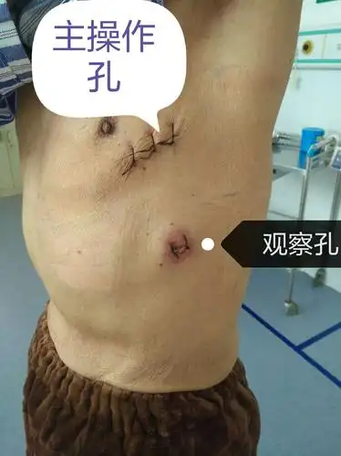 永城市人民医院胸外科手术分享