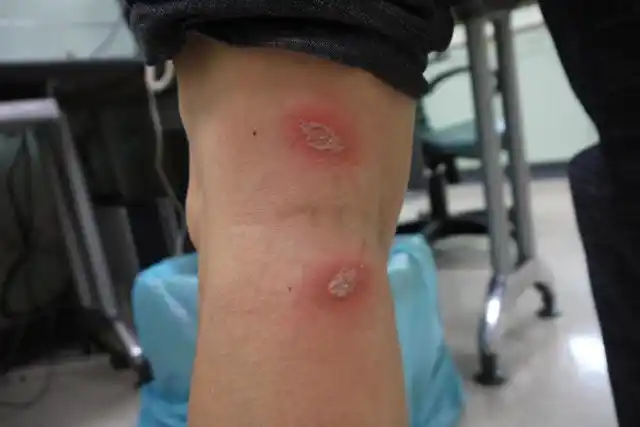 隐翅虫皮炎起初为点状片状伴瘙痒疼痛就诊前可用肥皂水清洗