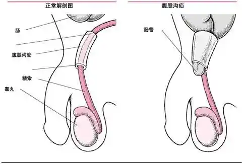 阴囊和睾丸的其他疾患睾丸附睾炎是睾丸和附睾的炎症.