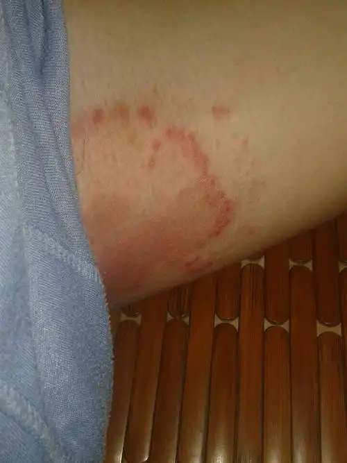 大腿内侧长了这些东西,有一周时间了,期间用了醋酸氟轻松乳膏.