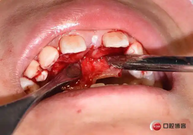 局麻与全麻的抉择微创无痛拔除上颌腭部埋伏多生牙
