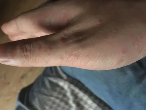 手上长了很多红色的小颗粒,手心手背都有,什么情况?