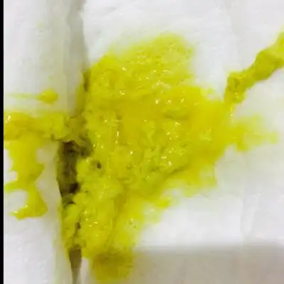 宝宝四个月 拉的大便 黄白色 好多粘液 怎麼回事 怎麼办啊