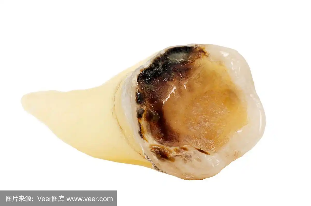 摘除的龋齿孤立在白色背景近景,下臼齿