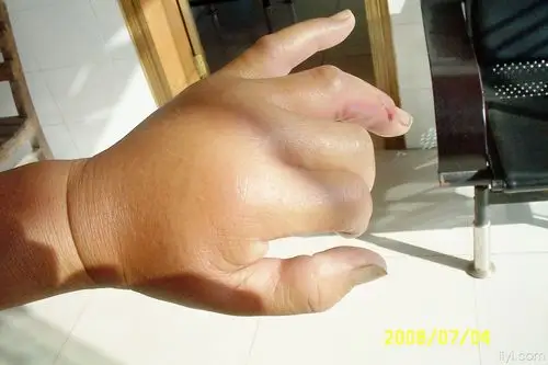 蜈蚣咬伤2天如图如何处理