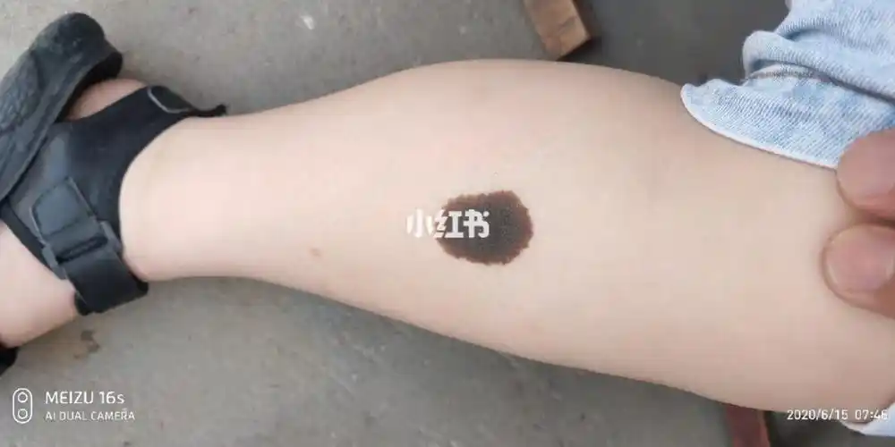 小孩腿上的黑胎记,怎么弄,长大了不少