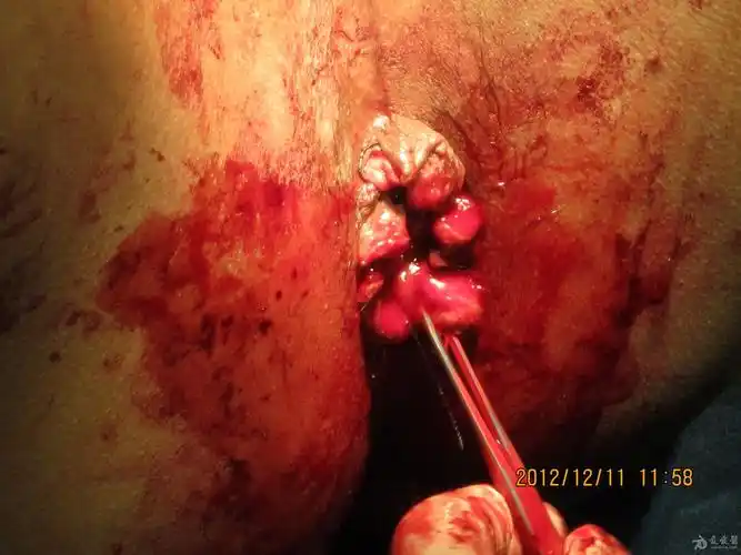 环状混合痔1例 - 肛肠外科讨论版 - 爱爱医医学论坛