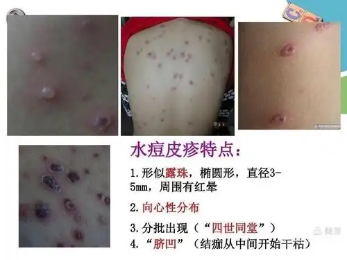 "普及知识,预防为先"——海区二幼水痘预防知识宣传.