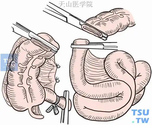 右半结肠切除术 - 外科手术学 - 天山医学院