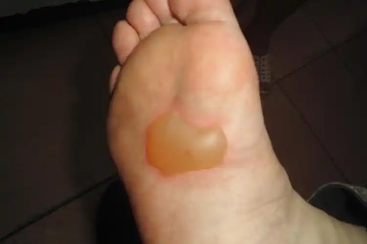 脚心6公分的水泡是剌穿还是不剌穿