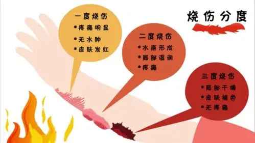 活用京万红,应对烧烫伤三个等级各有妙招