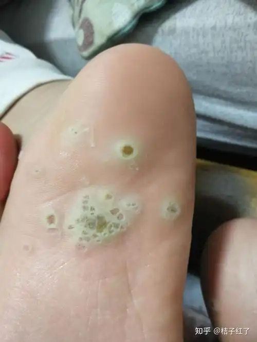 脚上感染长了疣,怎么弄. - 知乎