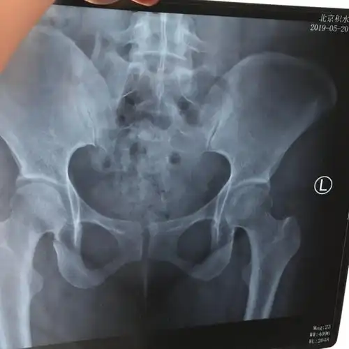 产后耻骨联合分离,松动,响