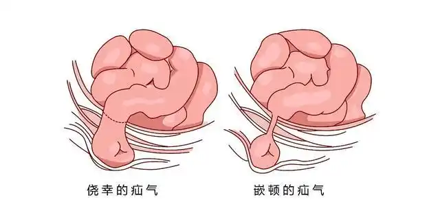 不主张采用疝气带,虽然可以缓解症状,但风险很大,使用不当导致嵌顿的