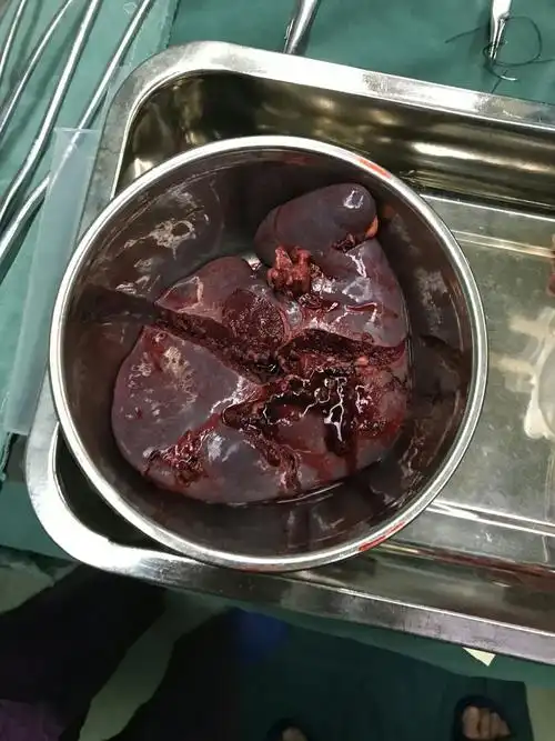 切掉的已破裂的脾脏