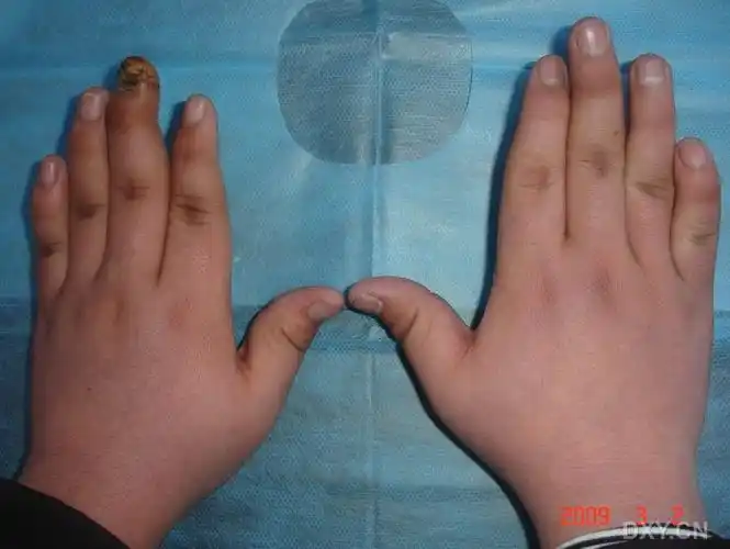 请教:双手鹅颈畸形-诊断?可能的原因?治疗? 查看