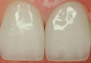 门牙烤瓷牙多少钱