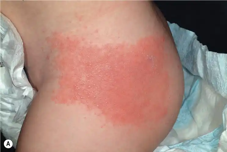 小儿接触性皮炎