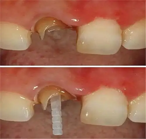【牙科技术知识分享】纤维桩临床使用心得