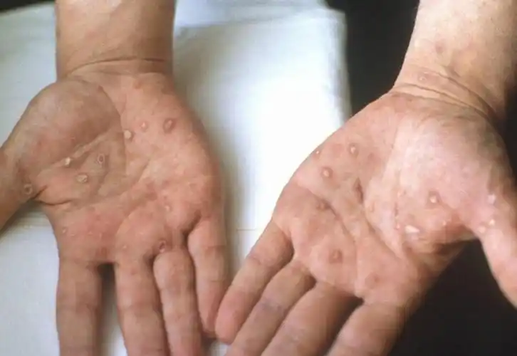 一期梅毒初期生殖器图片