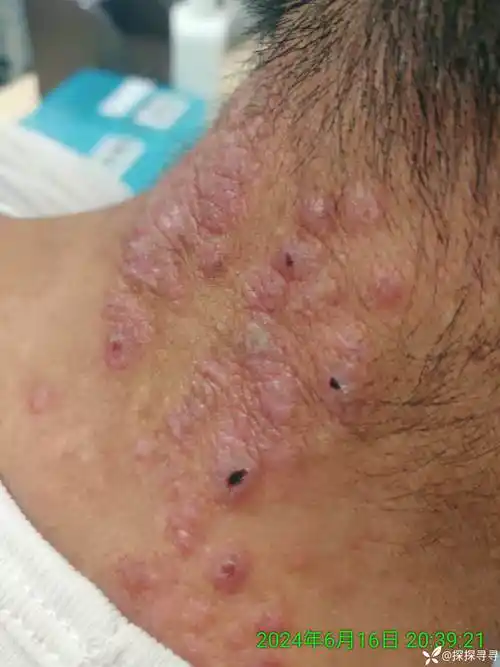 青年男性皮肤结节瘙痒症10余年