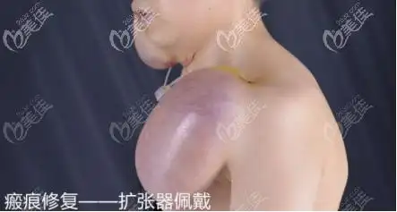 颈部下方佩戴扩张器的样子