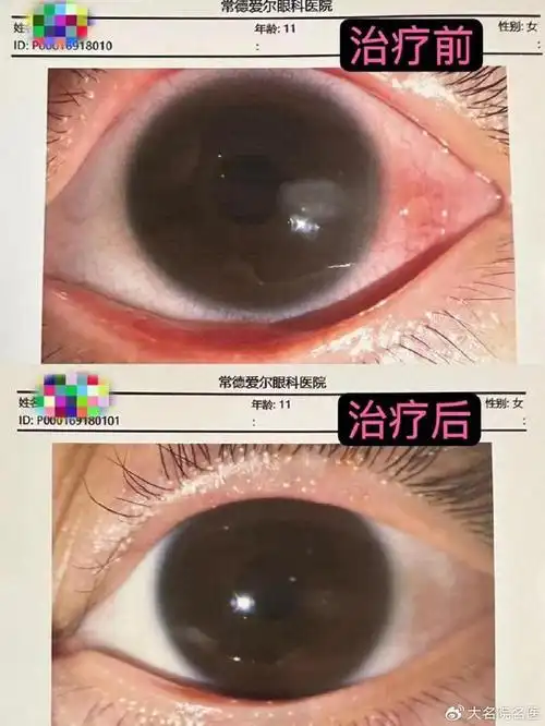 11岁女孩眼睛红成"兔子眼",竟是因为这种眼病在作祟