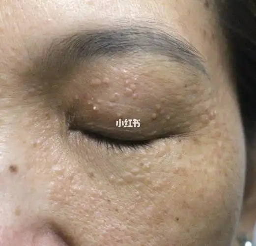 如何正确区分汗管瘤和扁平疣