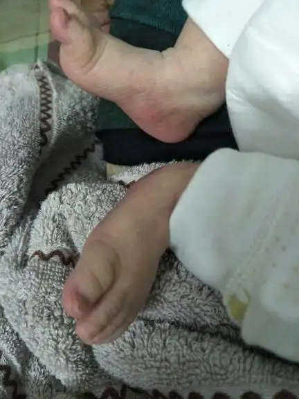 刚出生宝宝一只脚足外翻怎么办.好害怕