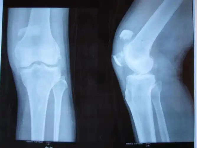 征集髌骨骨折x光片按要求提供给予积分