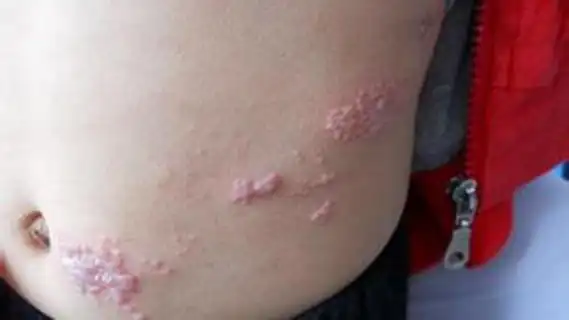 带状疱疹是如何感染的呢