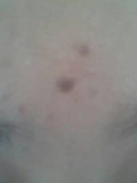 我的额头一直都很光滑,去年长了一个褐色小疙瘩,这是什么?