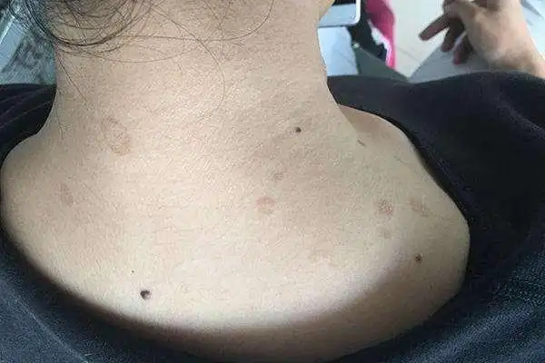 后背刚洗完澡就很痒,多半与毛孔里"住"的螨虫有关,它们在吃饭,所以