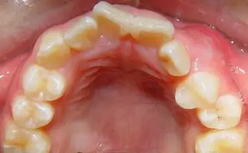 我今年22岁,想矫正牙齿(上前牙突出),但是不知道选择做烤瓷牙还是选择