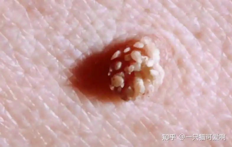 女性若有2个部位瘙痒,或是hpv"缠上"了,坚持3点可促你转阴 - 知乎