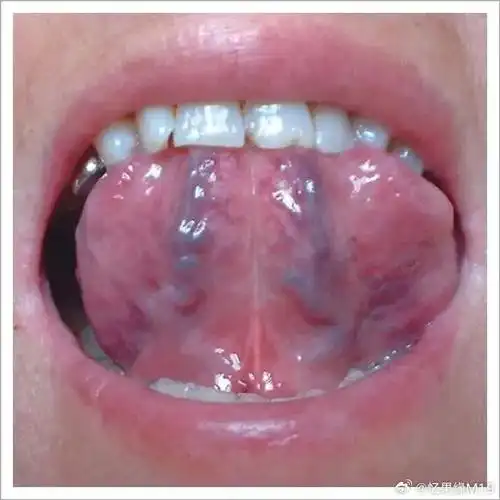 血虚比较厉害,"窥一管而知全豹",那么舌下的血管儿如此,全身的血液大