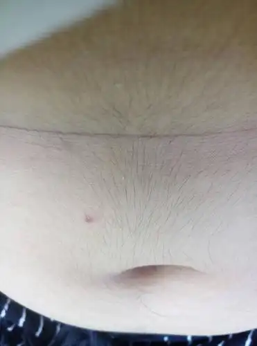 看下图,这是女生的肚子请问为什么会这样?又怎么能让这毛消失?