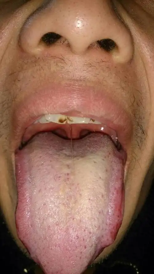 舌苔很厚,不痛,会是白色念珠菌吗