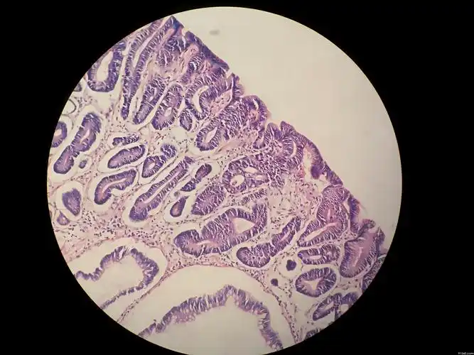 胃角esd高级别讨论病例山东省消化道早癌病理群