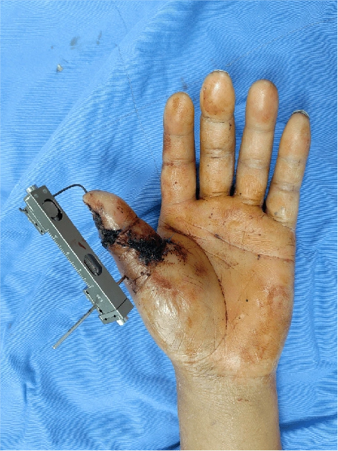 断指重生盘州这家医院不简单