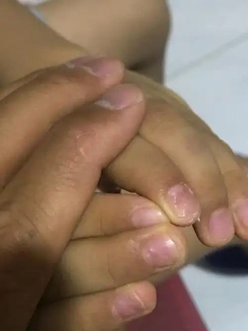 我儿子五岁,指甲出现这种情况是什么病啊?恳求各位大神能帮我诊断诊断