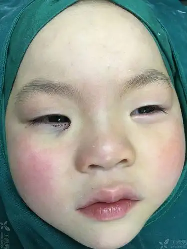期待随访照片~~ 如果瘢痕较宽,等小姑娘成年后做重睑 内眦赘皮矫正