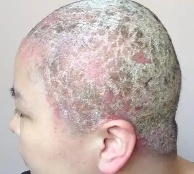 头上牛皮癣不能吃啥_饮食_护理治疗_牛皮癣银屑病_慢性病健康网