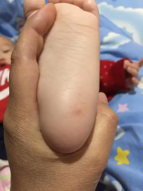 我家宝宝脚底板长啦小红点.不知道是什么好担心.