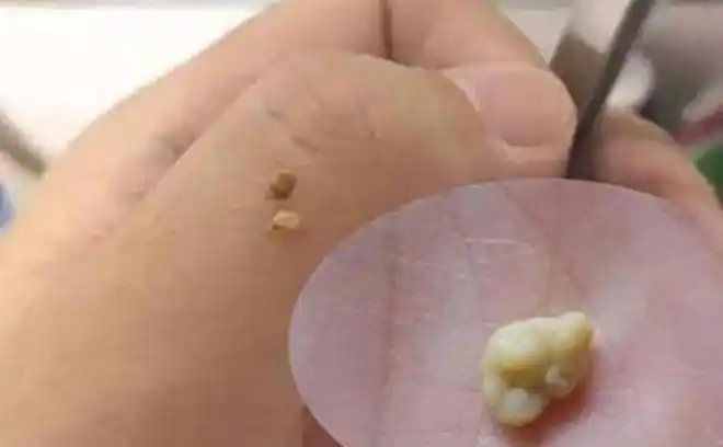 扁桃体结石每个人都会长吗? 掌握两个办法, 谁也不怕被它困扰