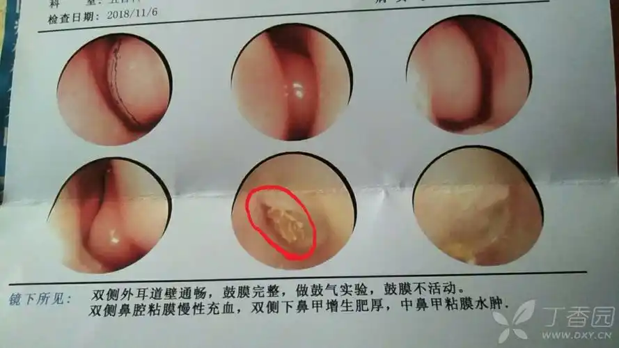 下鼻甲肥大致头疼,耳闷,请问需要手术治疗么? - 丁香园论坛