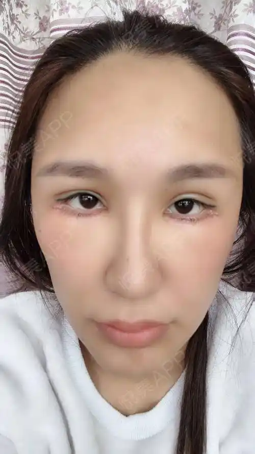 下睑下至术后2天_眼型矫正术后2天_眼部整形术后2天_低调出行有内涵