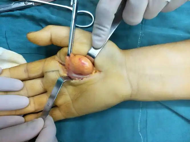 脂肪瘤压迫失功能,手外科帮她除病痛