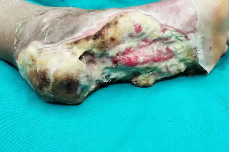 病毒等感染,可能会造成皮肤的损伤,可引起皮肤的破皮,溃烂,发痒等症状