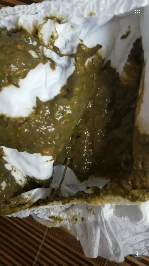 宝宝拉屎颜色是黑色的是怎么回事